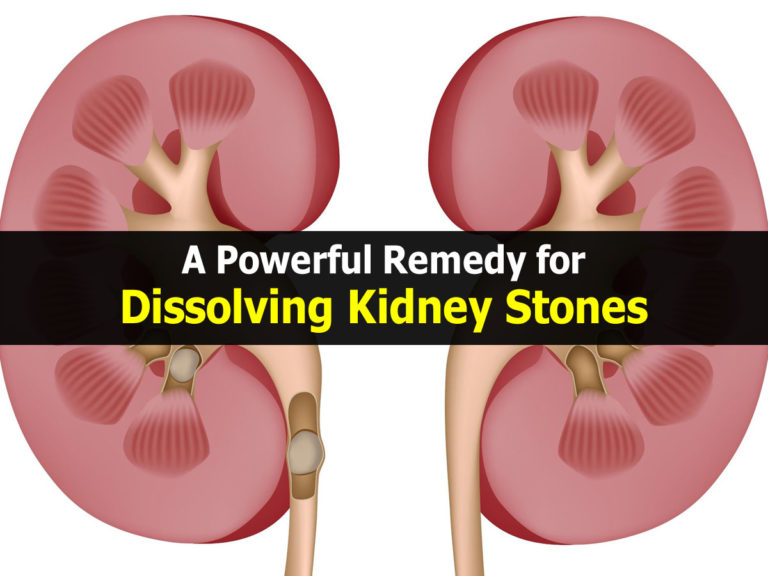 how to dissolve kidney stones with lemon juice dissolving kidney stones mayo clinic how to dissolve kidney stones with apple cider vinegar how to dissolve kidney stones naturally how to pass kidney stones fast chanca piedra for kidney stones how to pass a kidney stone in 24 hours medicine to break up kidney stones