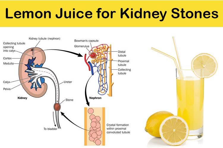 home remedy to break down kidney stones