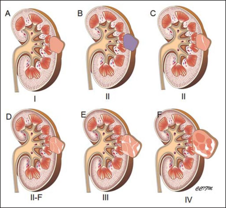 kidney cyst pain relief kidney cyst size cyst on kidney cancer symptoms how do they treat a cyst on the kidney? kidney cyst natural treatment cyst on kidney and blood in urine what does kidney cyst pain feel like kidney cyst removal