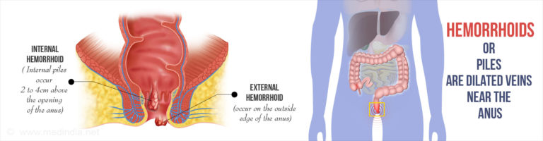 Hemorrhoids Causes and Prevention