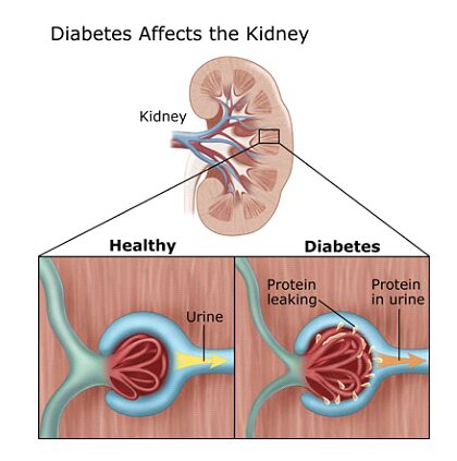 symptoms of diabetic kidney disease