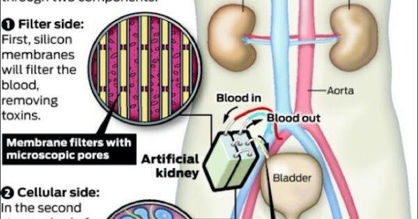 BIONIC KIDNEY