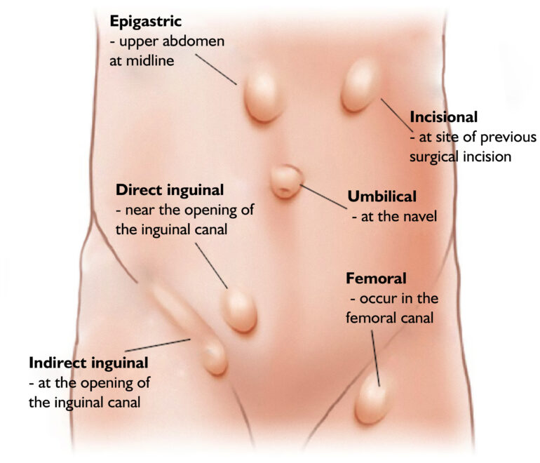 types of  Hernia